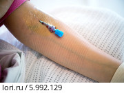 Катетер (иголка) для капельницы в вене пациента. Стоковое фото, фотограф Сергей Левыкин / Фотобанк Лори