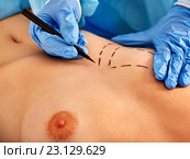Doctor makes dotted line on female breast . Стоковое фото, фотограф Gennadiy Poznyakov / Фотобанк Лори