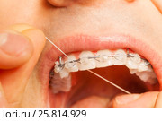 Man with braces on teeth using dental floss. Стоковое фото, фотограф Сергей Новиков / Фотобанк Лори