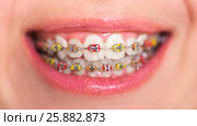 Close-up shot of multicolored bracket systems. Стоковое фото, фотограф Кирилл Греков / Фотобанк Лори