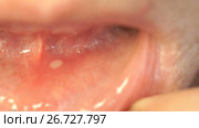Close-up of stomatitis into mouth. Стоковое видео, видеограф worker / Фотобанк Лори