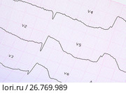 Экстренная кардиология и интенсивная терапия. ЭКГ с острым периодом крупноочагового распространённого переднего инфаркта миокарда. Стоковое фото, фотограф Ольга Коцюба / Фотобанк Лори
