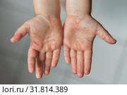 Enterovirus Leg arm mouth Rash on the body of a child Cocksackie virus. Стоковое фото, фотограф Irina Kuchugurina/Gaudy / Фотобанк Лори