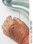Acupuncture treatment. Стоковое фото, фотограф Hans-Joachim Schneider / PantherMedia / Фотобанк Лори