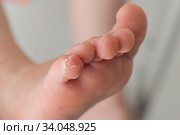Enterovirus foot hand mouth Skin peeled off on the body of a child Cocksackie virus. Стоковое фото, фотограф Irina Kuchugurina/Gaudy / Фотобанк Лори