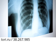 X-ray of the lungs. Chest x-ray. Viewing a picture of the lungs in the hospital on a reflective board,blurred focus. Стоковое фото, фотограф Светлана Акифьева / Фотобанк Лори
