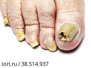 Fungal Nail Infection. Стоковое фото, фотограф Lekcej / Фотобанк Лори