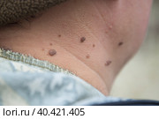 Papillomas on the human neck. Removal of papillomas. Стоковое фото, фотограф Александр Поташев / Фотобанк Лори
