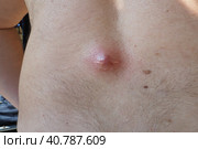 Abscess furuncle carbuncle on male hairy back. Clogged pore leading to skin inflammation. Surgical solution of cosmetic problems. Redness, swelling and pimple formation. Dermatology and surgery. Стоковое фото, фотограф Юлия Петровская / Фотобанк Лори
