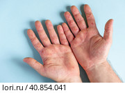 Painful rash, red spots blisters on the hand. Close up Allergy rash, human hands with dermatitis and Health problem. Ill eczema skin of patient. Viral Diseases. Red rashes on the palm. Enterovirus. Стоковое фото, фотограф Марина Демидюк / Фотобанк Лори