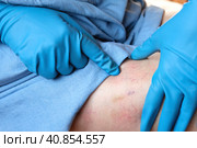 Phlebologist examines a patient with varicose veins on his leg. Leg pain. Phlebology. Venous pathologies of the lower extremities. Human vessel, arteries. Capillaries. Blood system. Health legs. Стоковое фото, фотограф Марина Демидюк / Фотобанк Лори