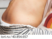 Back of Small Child with Red Rash. Baby with Red Spots Blisters on the skin. Close up of Painful Rash. Health Problem. Rubella, Chickenpox, Scarlet fever, Measles. Bacterial Infections, Disease. Стоковое фото, фотограф Марина Демидюк / Фотобанк Лори