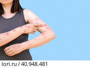 Monkeypox new disease dangerous over the world. Patient with Monkey Pox. Painful rash, red spots blisters on the hand. Close up rash, human hands with Health problem. Banner, copy space. Стоковое фото, фотограф Марина Демидюк / Фотобанк Лори