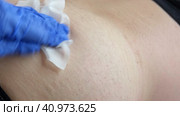 Needle injecting into the muscle. Nurse doing a trigger point injection in patient back. Close up doctor makes an shot therapy. Alternative pain treatment. Covid-19, pox, MPOX, flu virus vaccine. Стоковое видео, видеограф Марина Демидюк / Фотобанк Лори