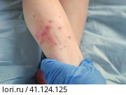 Doctor hands examining infant leg. Little Kid allergy. Closeup. Child scratches a red rash. Nurse applies a special cream to atopic skin. Dermatitis, diathesis, irritation on the baby body. Pruritus. Стоковое фото, фотограф Марина Демидюк / Фотобанк Лори