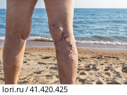 Female sore legs with bulging veins along the back of the lower leg. Varicose veins in women. Стоковое фото, фотограф Коханова Наталья / Фотобанк Лори