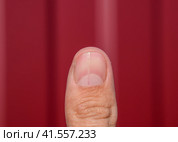Forked nail on the thumb. Dilation of the nail, traumatic pathology. The nail is divided in half. Стоковое фото, фотограф Леонид Еремейчук / Фотобанк Лори