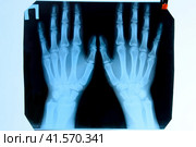X ray of the hands, a picture of the bones of the hands on the x-ray. Стоковое фото, фотограф Леонид Еремейчук / Фотобанк Лори