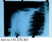 X-ray of shoulder and clavicle, X ray picture of shoulder joint. Стоковое фото, фотограф Леонид Еремейчук / Фотобанк Лори