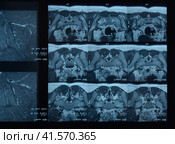 MRI sacroiliac articulation. Study of ankylosing spondyloarthritis patient. Стоковое фото, фотограф Леонид Еремейчук / Фотобанк Лори