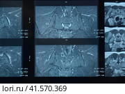MRI sacroiliac articulation. Study of ankylosing spondyloarthritis patient. Стоковое фото, фотограф Леонид Еремейчук / Фотобанк Лори