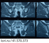 MRI sacroiliac articulation. Study of ankylosing spondyloarthritis patient. Стоковое фото, фотограф Леонид Еремейчук / Фотобанк Лори