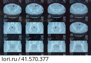MRI sacroiliac articulation. Study of ankylosing spondyloarthritis patient. Стоковое фото, фотограф Леонид Еремейчук / Фотобанк Лори