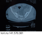 MRI sacroiliac articulation. Study of ankylosing spondyloarthritis patient. Стоковое фото, фотограф Леонид Еремейчук / Фотобанк Лори
