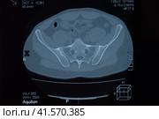 MRI sacroiliac articulation. Study of ankylosing spondyloarthritis patient. Стоковое фото, фотограф Леонид Еремейчук / Фотобанк Лори