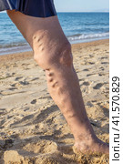 Woman's leg with varicose veins against the background of the sea. Spa treatment for sore legs. Стоковое фото, фотограф Коханова Наталья / Фотобанк Лори
