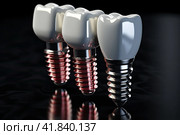 Tooth implant and teeth on a black background. Стоковое AI-изображение, AI-художник Ирина Михайличенко / Фотобанк Лори