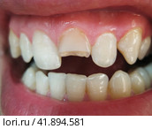 Broken tooth. Broken upper incisor in a man mouth. Стоковое фото, фотограф Леонид Еремейчук / Фотобанк Лори