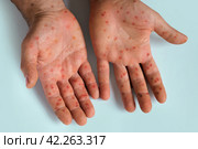 Human Hands with Painful Rash, Red Spots Blisters on the Skin. Health Problem. Monkeypox Disease Symptoms. Male Patient Arms with Monkey Pox. Close Up. Banner, Copy Space. Dengue Fever Infection, MPOX. Стоковое фото, фотограф Марина Демидюк / Фотобанк Лори