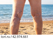 woman at sea with sore legs, bumps on her shins, thrombophlebitis of the veins of the lower extremities. Стоковое фото, фотограф Коханова Наталья / Фотобанк Лори