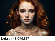 Leukoderma. Vitiligo. Violation of skin pigmentation. Large white spots all over the body and face. Portrait of a beautiful girl with a skin disease. Стоковое AI-изображение, AI-художник Photojuli / Фотобанк Лори
