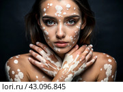 Leukoderma. Vitiligo. Violation of skin pigmentation. Large white spots all over the body and face. Portrait of a beautiful girl with a skin disease. Стоковое AI-изображение, AI-художник Photojuli / Фотобанк Лори