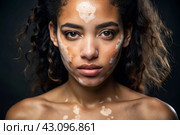 Leukoderma. Vitiligo. Violation of skin pigmentation. Large white spots all over the body and face. Portrait of a beautiful girl with a skin disease. Стоковое AI-изображение, AI-художник Photojuli / Фотобанк Лори