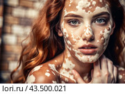 Leukoderma. Vitiligo. Violation of skin pigmentation. Large white spots all over the body and face. Portrait of a beautiful girl with a skin disease. Стоковое AI-изображение, AI-художник Photojuli / Фотобанк Лори