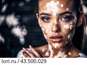 Leukoderma. Vitiligo. Violation of skin pigmentation. Large white spots all over the body and face. Portrait of a beautiful girl with a skin disease. Стоковое AI-изображение, AI-художник Photojuli / Фотобанк Лори