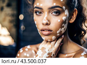 Leukoderma. Vitiligo. Violation of skin pigmentation. Large white spots all over the body and face. Portrait of a beautiful girl with a skin disease. Стоковое AI-изображение, AI-художник Photojuli / Фотобанк Лори