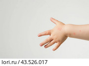 Рука с атопическим дерматитом, псориаз, расчес, зуд. Стоковое AI-изображение, AI-художник Терехова Марина / Фотобанк Лори