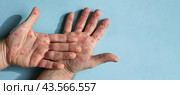Male hands with Monkeypox rash. Patient with MonkeyPox viral disease. Close Up of Painful rash, red spots blisters on the skin. Human palm with Health problem. Banner, copy space. Allergy, dermatitis. Стоковое фото, фотограф Марина Демидюк / Фотобанк Лори