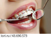 The dentist examines the patient's teeth after installing braces. Стоковое AI-изображение, AI-художник Ярославский Максим / Фотобанк Лори