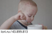 Little boy affected with chickenpox eats from plate with spoon face covered in redness. Despite facial redness tries to enjoy his meal Redness on his face indicates severity of condition. Стоковое видео, видеограф Olesia Kondrateva / Фотобанк Лори
