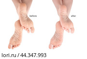 Feet with dry skin before and after treatment. dry chapped skin on feet requiring care isolated on white background, dry skin on heels and soles needs care. Стоковое фото, фотограф Павел Муравьев / Фотобанк Лори