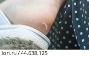 A callus on a woman's heel from uncomfortable shoes. Close-up of a woman's heel with a callus. Стоковое фото, фотограф Скрипачев Антон / Фотобанк Лори