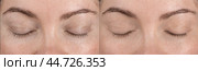 Skin around eyelids, eyes before and after application of care cosmetics or cosmetic procedures, creams, serums, masks. Part of face of middle-aged woman in two versions. Стоковое фото, фотограф Павел Муравьев / Фотобанк Лори