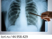 X-ray of the lungs. Chest x-ray. Doctor's view of the lung image in the hospital on a reflective board, blurred focus. Стоковое фото, фотограф Светлана Акифьева / Фотобанк Лори