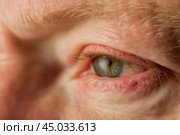 Human Eye with Conjunctivitis extreme close up. Closeup irritated infected red bloodshot eye. Male Eye. Vision. Eyesight. Mature Adult Eye Opening Wide. Viral infection with redness of eyeball. Macro. Стоковое AI-изображение, AI-художник Марина Демидюк / Фотобанк Лори