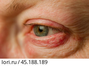 Human Eye with Conjunctivitis extreme close up. Closeup irritated infected red bloodshot eye. Male Eye. Vision. Eyesight. Mature Adult Eye Opening Wide. Viral infection with redness of eyeball. Macro. Стоковое AI-изображение, AI-художник Марина Демидюк / Фотобанк Лори